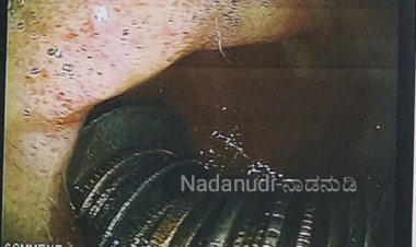 ವ್ಯಕ್ತಿ ಹೊಟೆಯಲ್ಲಿ ಸಿಕ್ಕಿತು 187 ನಾಣ್ಯ: ಬಾಗಲಕೋಟೆಯಲ್ಲೊಂದು ಅಪರೂಪದ ಶಸ್ತ್ರಚಿಕಿತ್ಸೆ